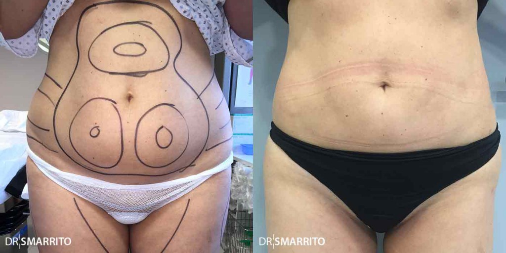 Liposuccion femme : photo Avant Après